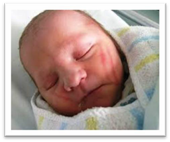 Temporary red marks on a baby’s face following a forceps birth.