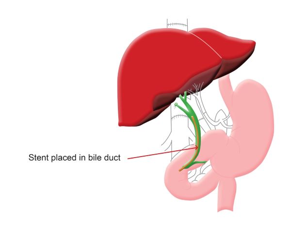 The “Piggy Back” technique for sewing the new liver in